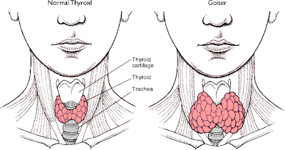 Image result for bahaya hipertiroid