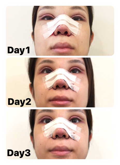 rhinoplasty nose eyelids epi epicanthoplasty zhongxiao dunhua zhongxiaodonglu