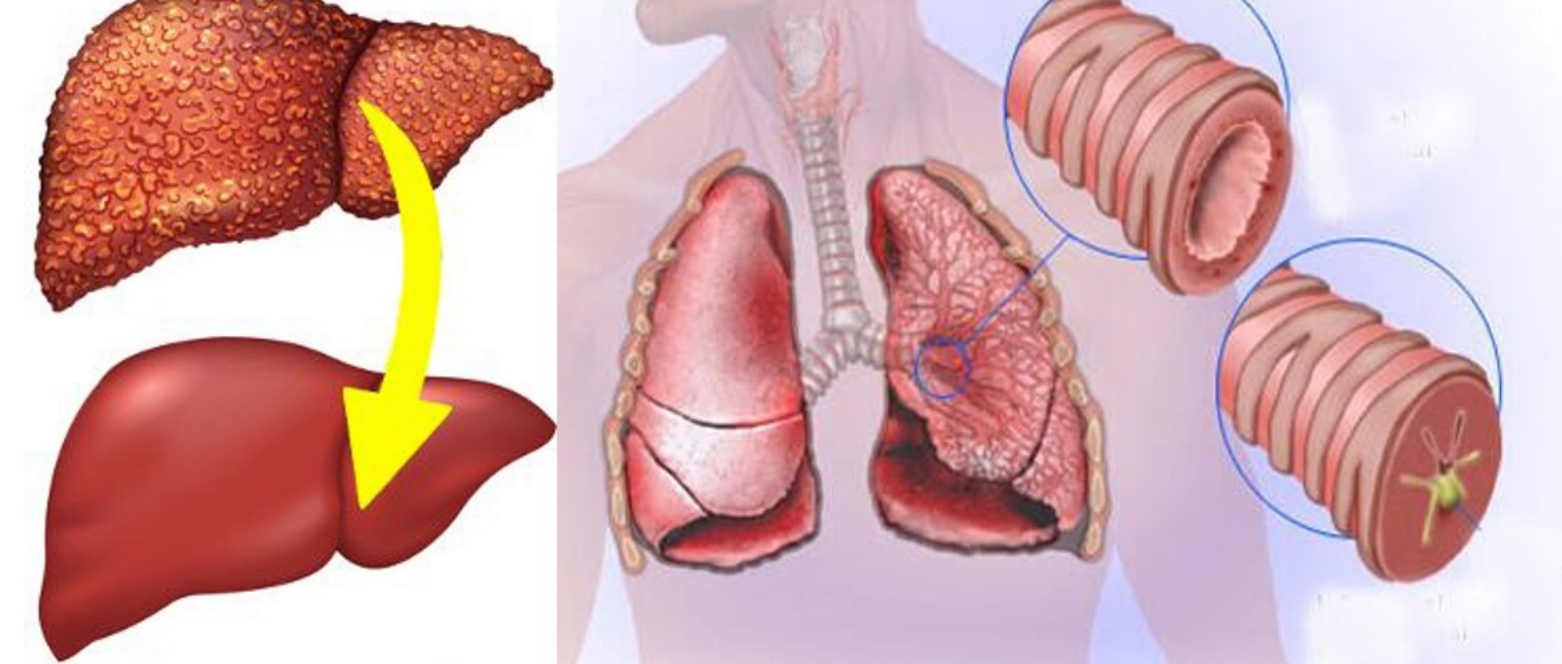 заразен ли сухой кашель