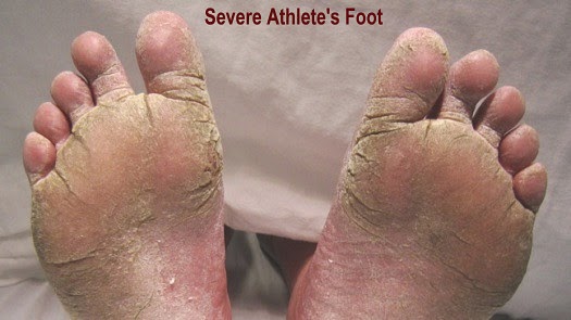 Severe Athlete's Foot