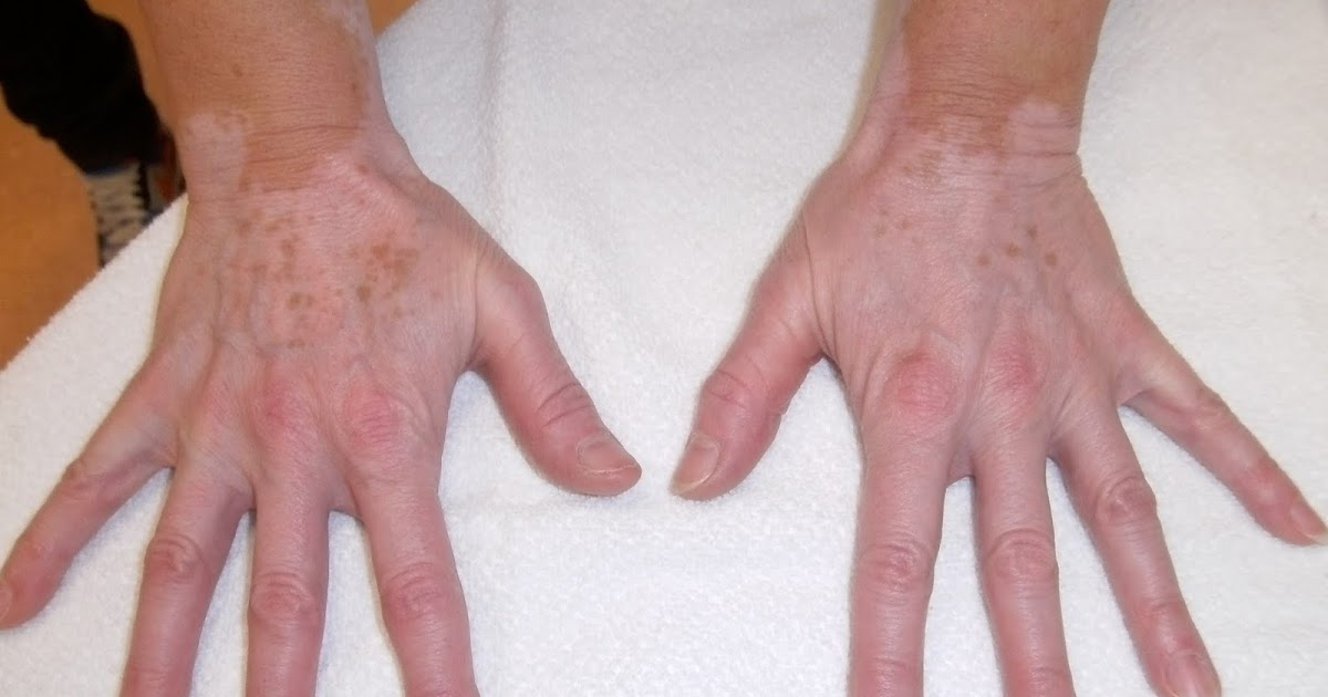 Rheumatologe Vitiligo in a Patient with Rheumatoid Arthritis under Methotrexate