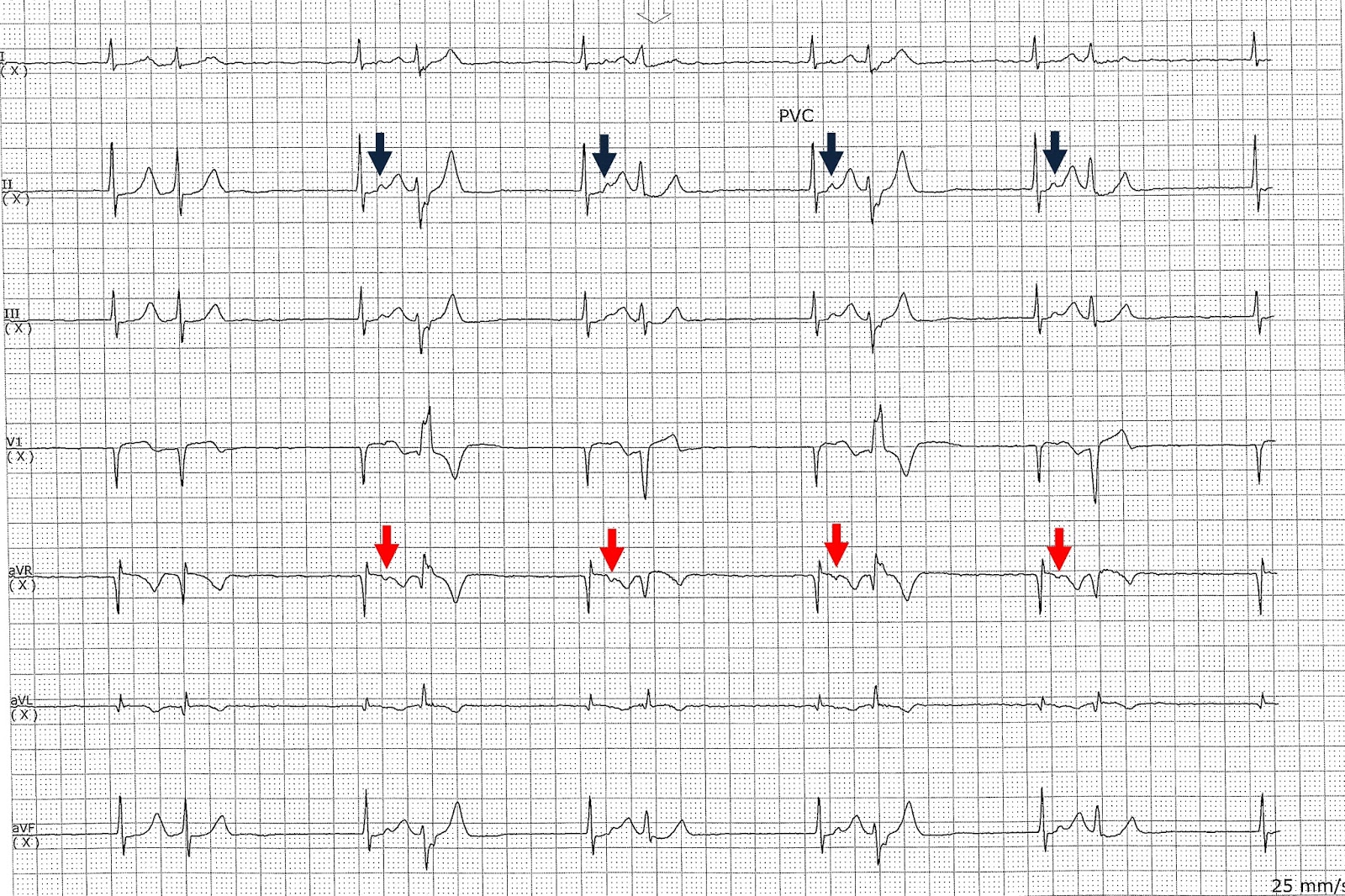 ECG Rhythms: Escape capture Bigeminy ECG Rhythms: Escape capture Bigeminy