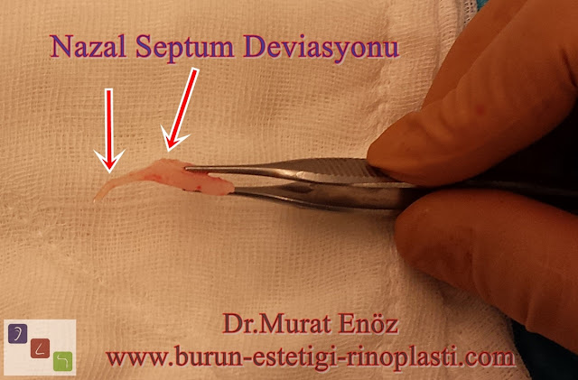 Septum deviasyonu - Burun kıkırdağı eğriliği - Nazal septum deviasyonu nasıl anlaşılır? - Deviasyon ameliyatı - Burun septumu eğriliği - Burun eğriliği