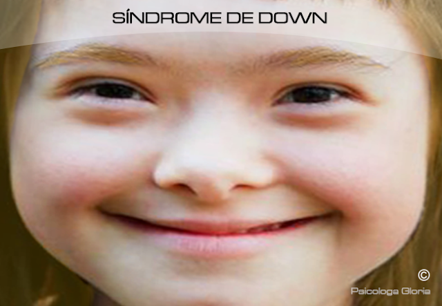 Qué es el Sindrome de Down