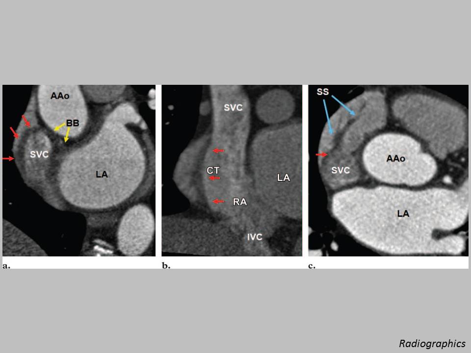 The Pump and the Tubes Crista Terminalis