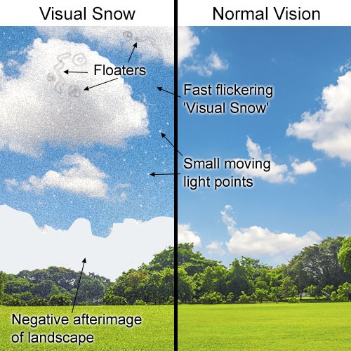 H.P.P.D. Research Visual Snow Published Data
