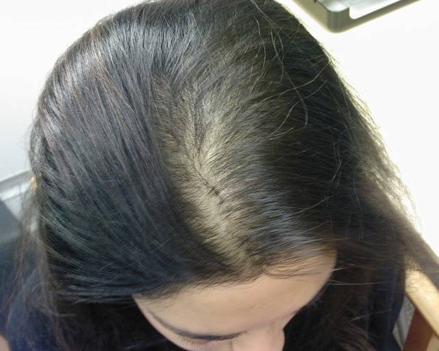 Non Surgical Hair Restoration Hair Restoration and more about Hair