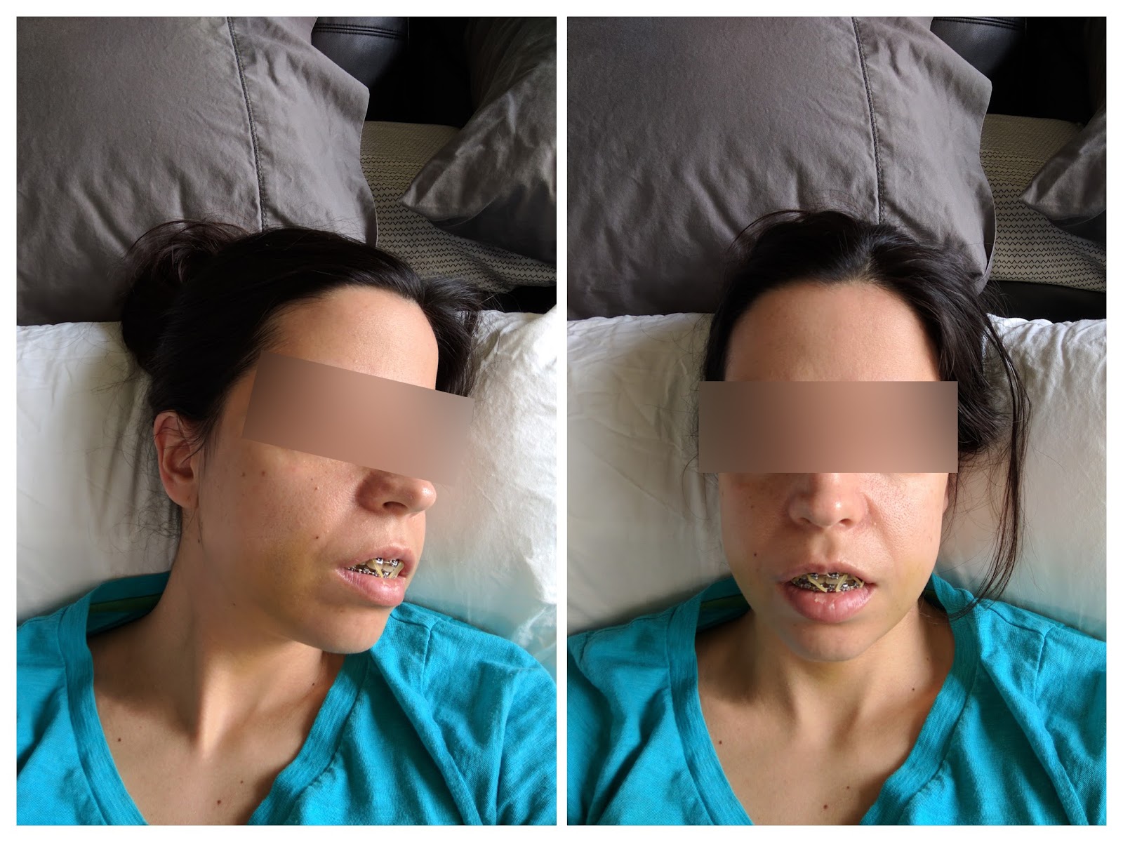 My Story Double Jaw Surgery and Septoplasty Photos