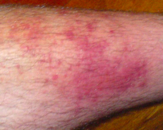 Recurrent Cellulitis: Robust Information From an RCT