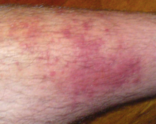 Cellulitis-Topic Overview – WebMD