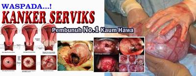Obat Kanker Serviks