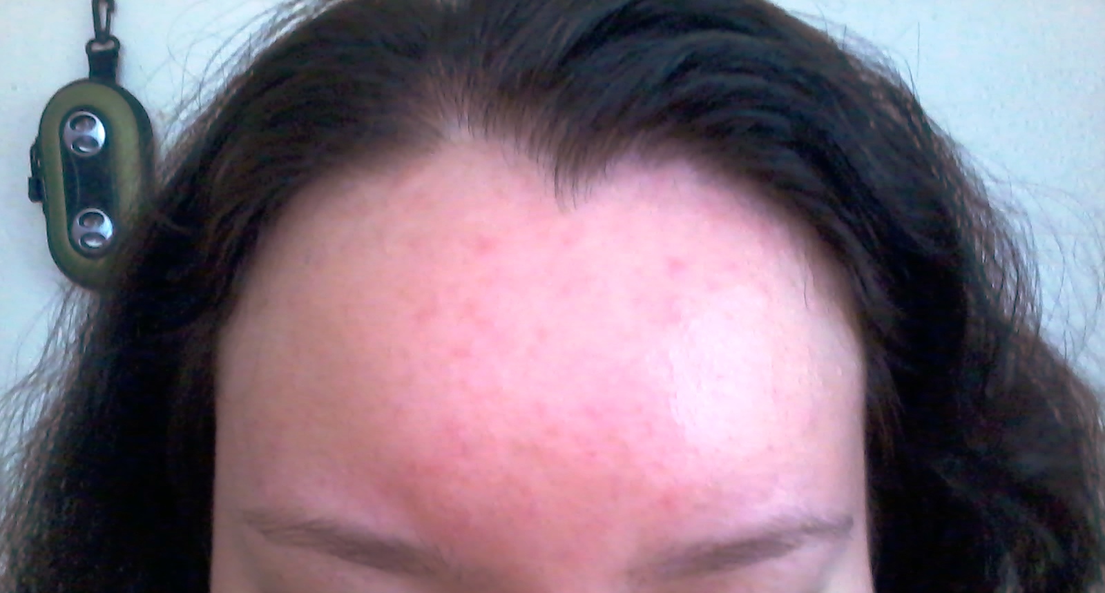 Hair Dye Rash On Face _ Hand Rash: 12 Possible Causes and Treatment ...