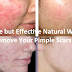 Simple but Effective Natural Ways to Remove Your Pimple Scars!