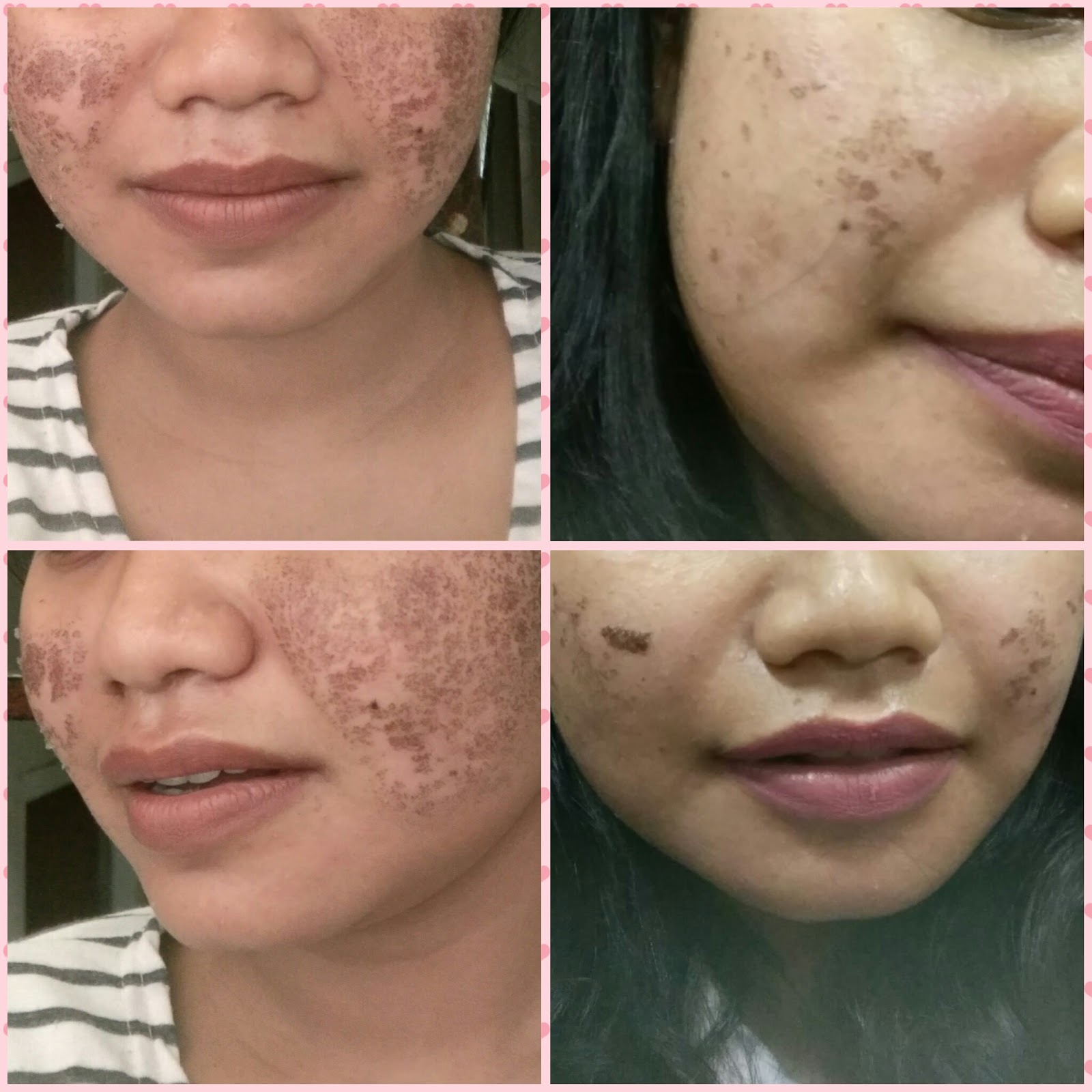 Membasmi scar alias bopeng bekas jerawat Laser Fractional CO2 Part