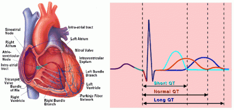 Tratamiento psicológico ante diagnóstico Síndrome Brugada