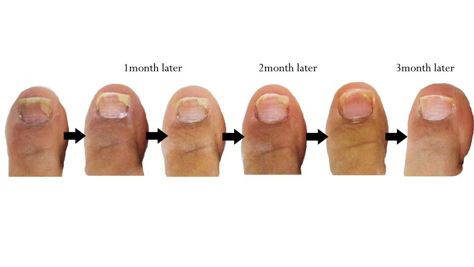 how to treat early fungal nail infection