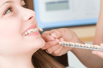 Dán răng sứ veneer hiện nay rất phổ biến