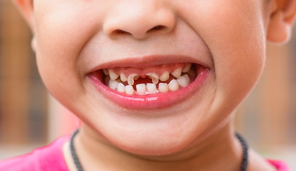  Tại sao trẻ em hay bị sâu răng