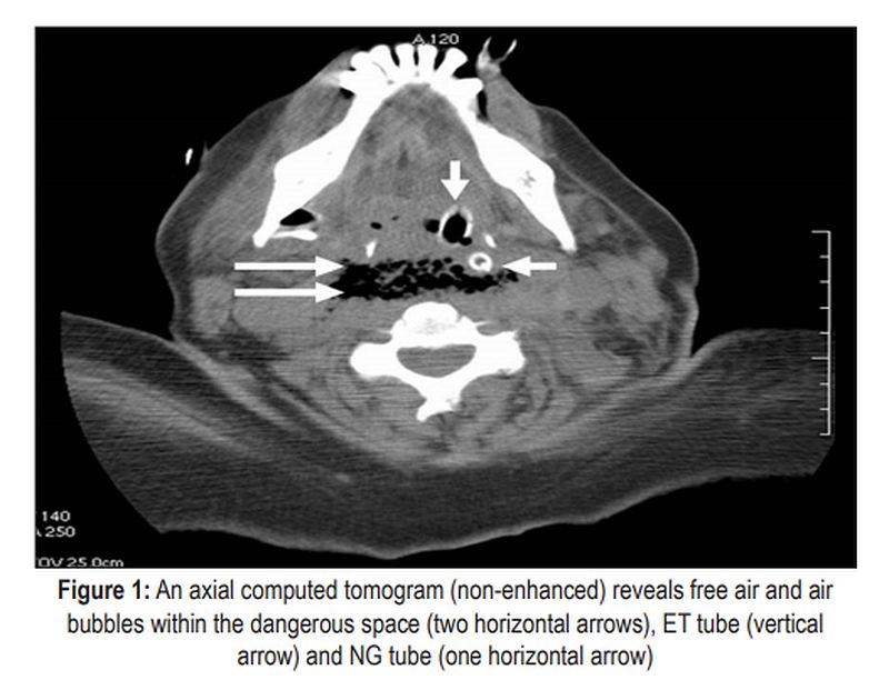 PDF Dangerous space emphysema after dental treatment