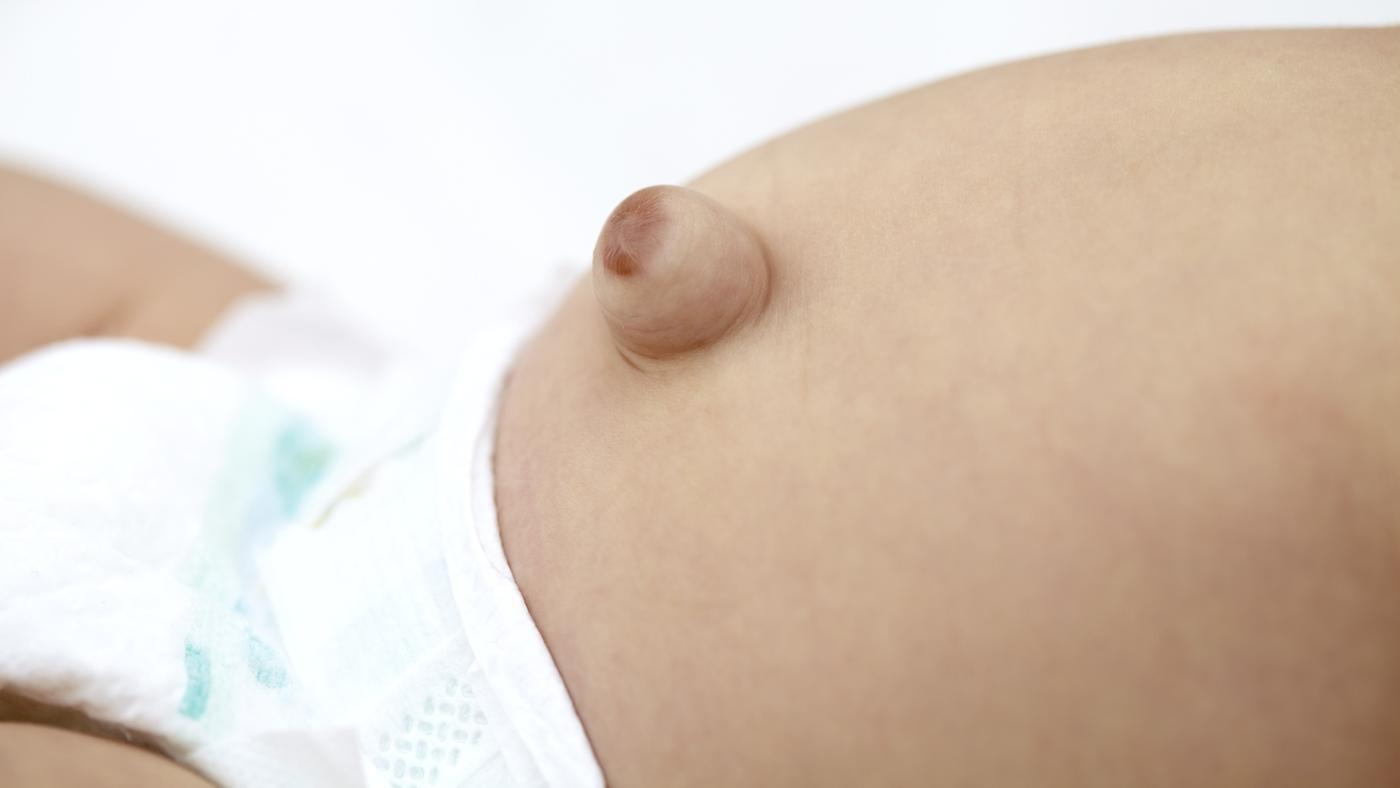Como corregir una hernia umbilical en bebes