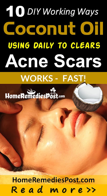 Coconut Oil For Acne Scars, Coconut Oil Acne Scars, Is Coconut Oil Good For Acne Scars, Does Coconut Oil Help Acne Scars, How To Use Coconut Oil For Acne Scars, Does Coconut Oil Work For Acne, Coconut Oil And Acne Scars,