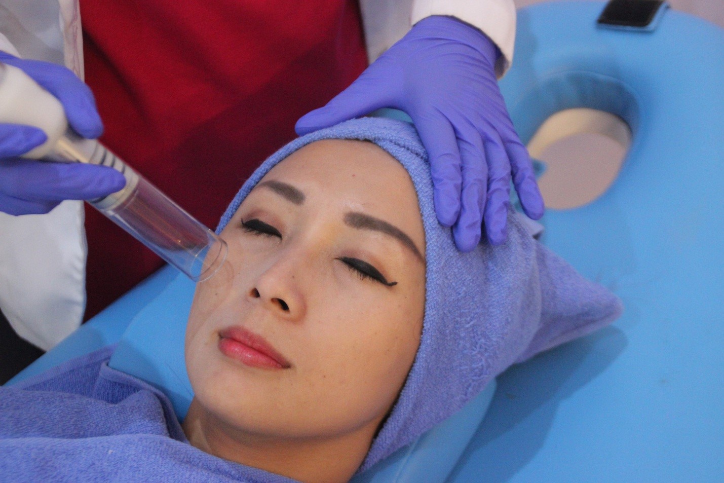revlite laser treatment