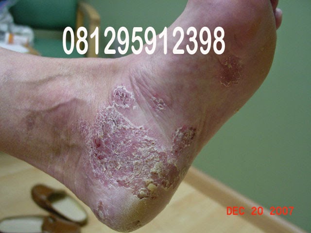 Obat gatal  pada  kulit kaki 