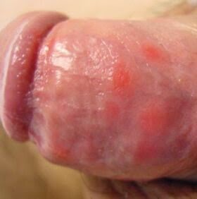 Obat Infeksi Menular Seksual Obat Infeksi Menular Seksual