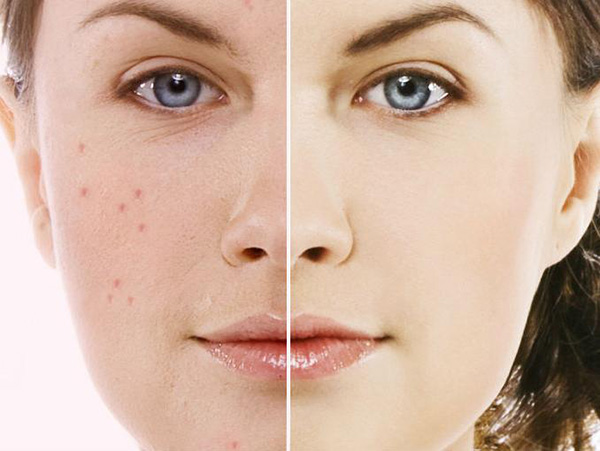 to accutane acne alternative for