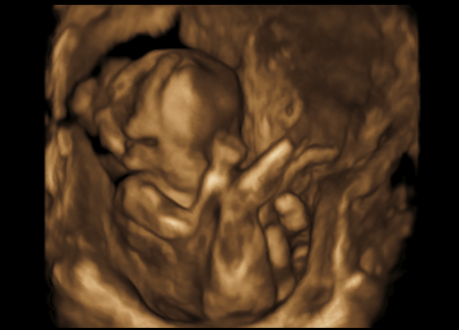 What is trisomy 18? Rumer's Rainbow