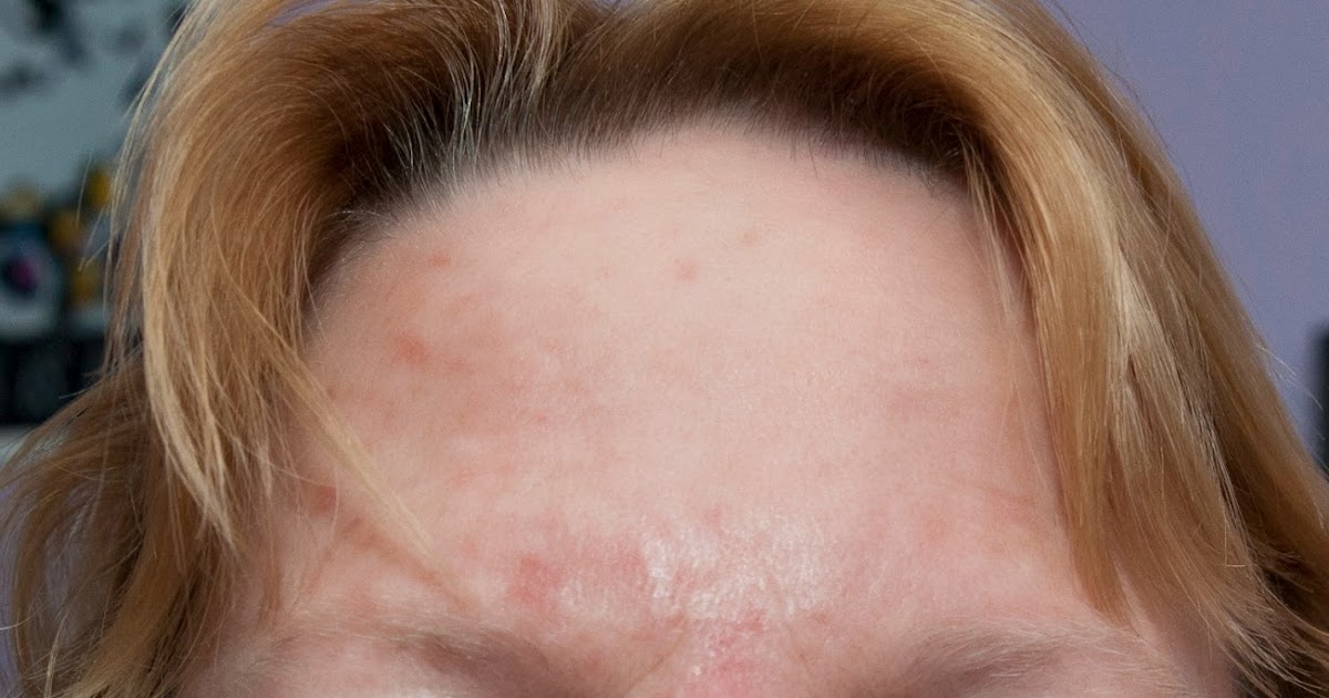 Photos By Nanci Blog Actinic Keratosis The Most Common Pre Cancer