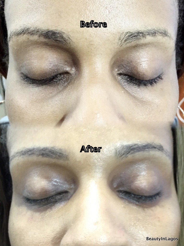 DERMAL FILLERS AND CHEMICAL PEELS IN LAGOS Beauty In Lagos