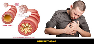 ASMA, Ini Cara Mengatasinya & Hal Hal Yg Harus Dihindarinya ASMA, Ini Cara Mengatasinya & Hal Hal Yg Harus Dihindarinya