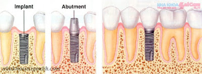 Cay ghep rang Implant co an toan co dau lam khong