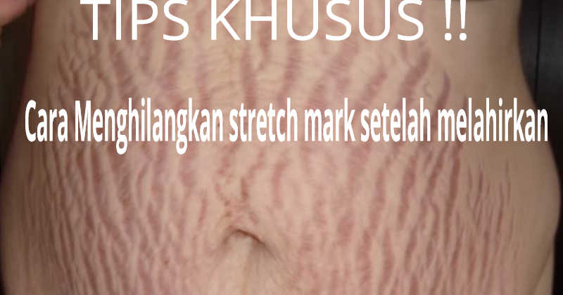 Bekas Stretchmark Setelah Melahirkan ini Ternyata Bisa di ...