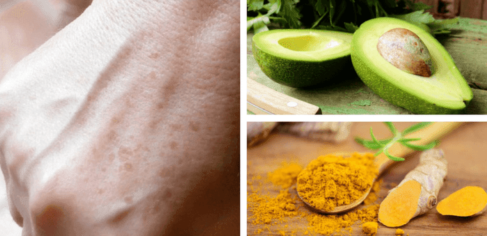 remedios para quitar las manchas de la piel