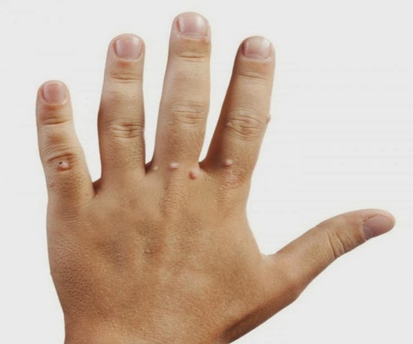 warts on hands teenager