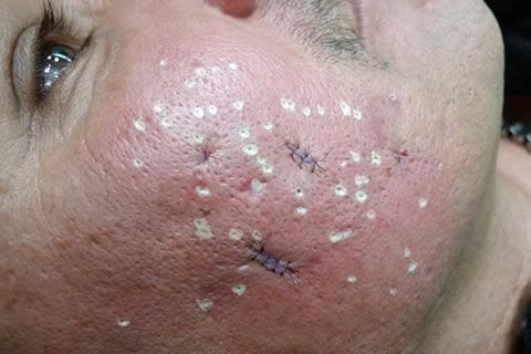 Live Surgery & Discussion with 80% Tricholoroacetic Acid - TCA CROSS for Deep Ice Pick Acne Scars