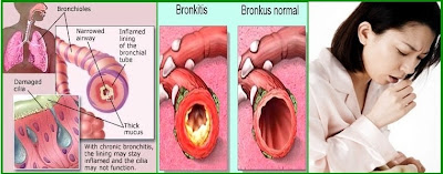 Batuk Bronchitis: Agustus 2013