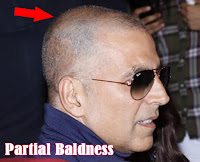 where to get, bollywood actor, akshay, kumar, partial baldness, picture