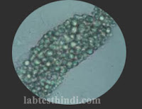 Urine Microscopic - Fatty casts