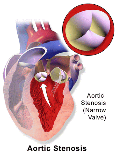 gambaran stenosis aorta