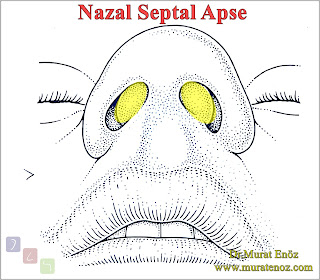 Nazal Septal Apse