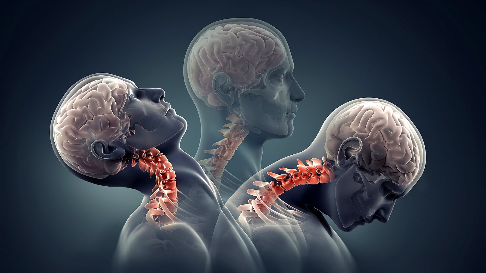 Cervical fracture Injury Neck Injury Choices