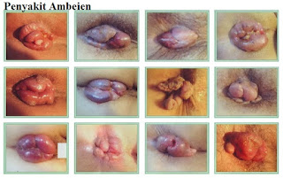 Cara Terbaik Menyembuhkan WASIR tanpa obat apotik