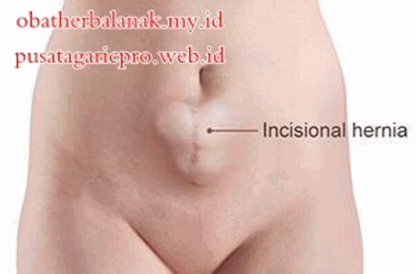 Pengobatan Hernia Herbal Tradisional Alami Pengobatan Hernia Herbal Tradisional Alami