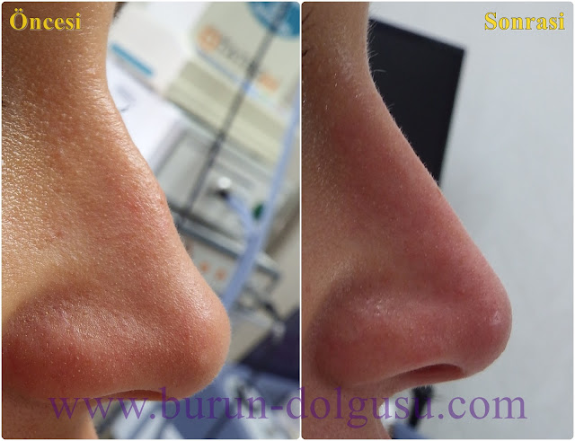 Non-surgical nose job - Non surgical nose job with filler in İstanbul - Non-surgical rhinoplasty in İstanbul - Nose tip filler augmentation in İstanbul - Non-surgical rhinoplasty in İstanbul - Nose filler injection in Turkey - The 5 Minute Nose Job in İstanbul, Turkey - Non-surgical nose job in Istanbul - Non-surgical nose job istanbul - Nose filler injection Turkey - Injectable nose job - Liquid rhinoplasty