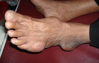 Gejala Fisik Asam Urat, Asam Urat Dilarang Makan Apa, Mengatasi Asam Urat Dan Kesemutan, Asam Urat Menyebabkan Kaki Bengkak, Obat Asam Urat Akut Tradisional, Suplemen Untuk Asam Urat Dan Kolesterol, Asam Urat Pada Punggung, Asam Urat Makan Kikil, Obat Asam Urat Dan Kolesterol Di Apotik, Pengobatan Asam Urat Dan Kolesterol, Cara Mengobati Penyakit Asam Urat Secara Tradisional, Mengobati Penyakit Asam Urat Secara Alami, Cara Mengatasi Nyeri Sendi Asam Urat, Obat Herbal Untuk Penyakit Asam Urat Dan Kolesterol, Asam Urat Makan Pisang, Penyebab Asam Urat Dan Ciri2nya, Alpukat Kolesterol Asam Urat, Penyakit Asam Urat Penyebabnya Apa, Cara Mengobati Asam Urat Dg Alami, Obat Asam Urat Terbukti Ampuh, Asam Urat Voltaren, Obat Oles Sakit Asam Urat, Cara Mengobati Asam Urat Dg Alami, Asam Urat Makanan, Obat Asam Urat Kolestrol Darah Tinggi, Penderita Asam Urat Tidak Boleh Makan, Cara Mengobati Asam Urat Dan Gula Darah, Www.Obat Tradisional Asam Urat.Com, Obat Alami Buat Sakit Asam Urat, Penyebab Asam Urat Dan Apa Obatnya
