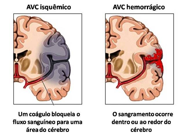 SECUELAS DE ACV HEMORRAGICO PDF DOWNLOAD SECUELAS DE ACV HEMORRAGICO PDF DOWNLOAD