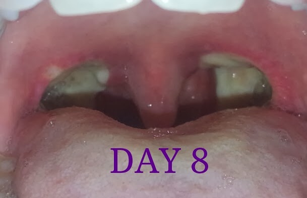 Jill s Tonsillectomy Day 8 jill-s-tonsillectomy-day-8